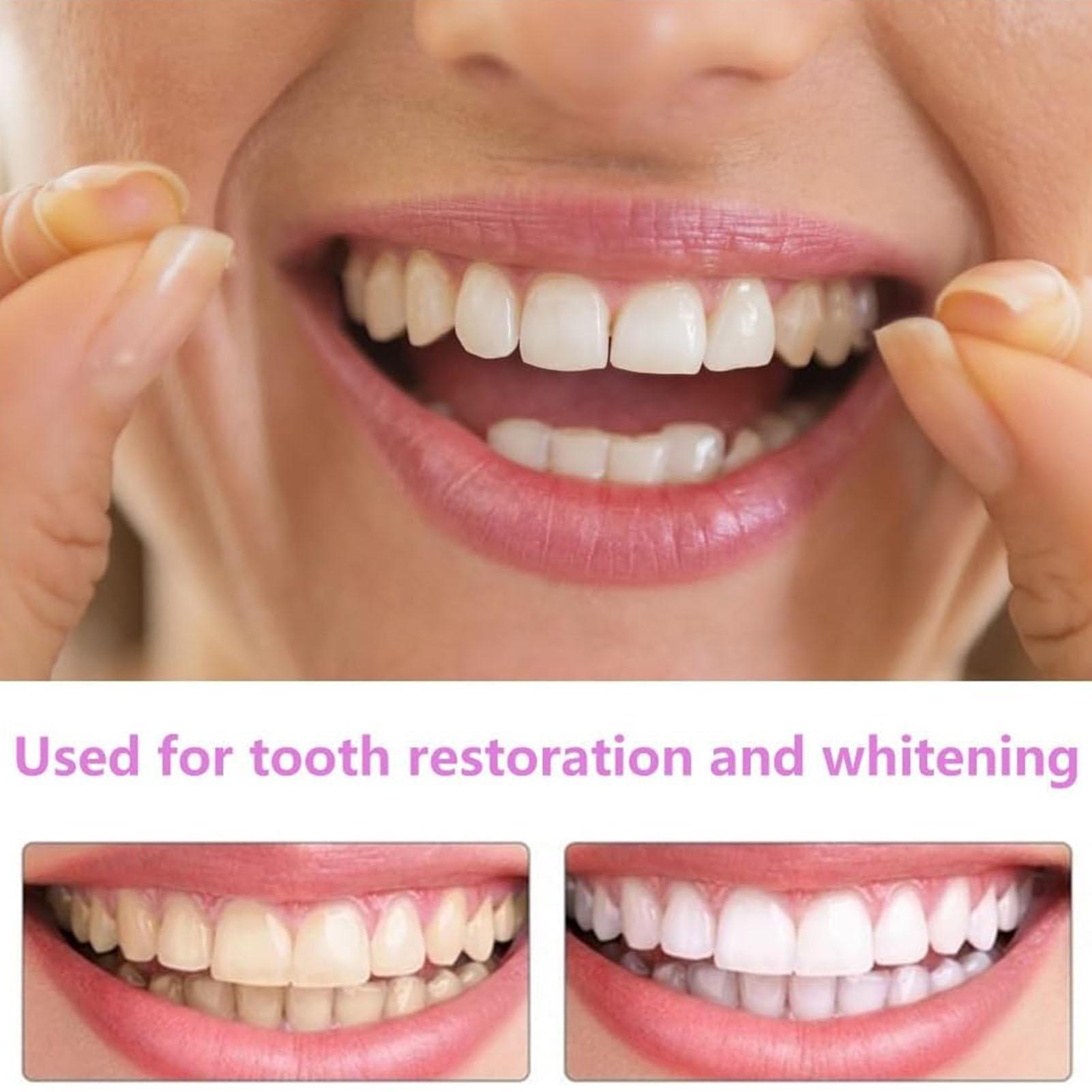 Tandvellen Boven- en ondervell - Teeth Whitening Mask recensie en prijs