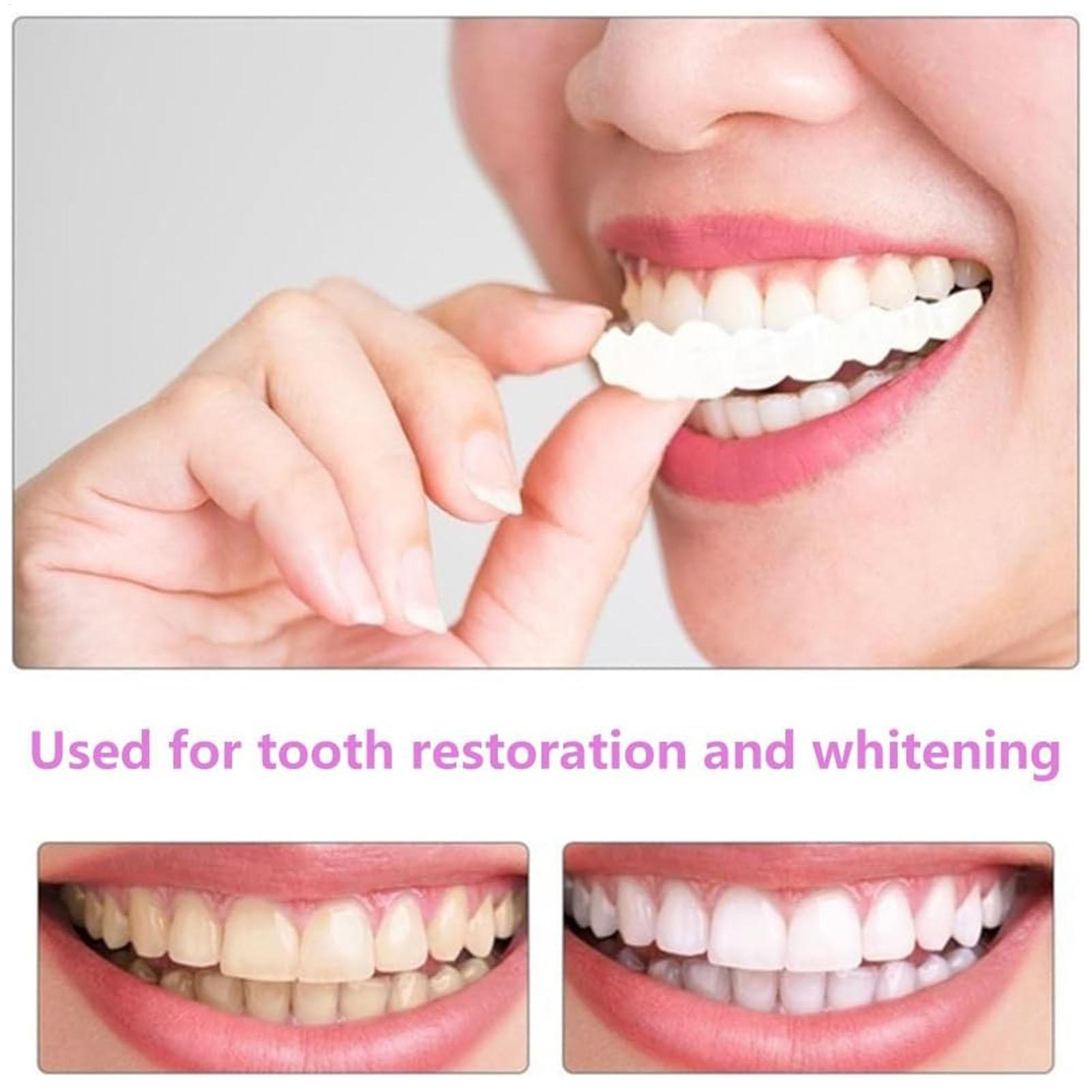 Tandvellen Boven- en ondervell - Teeth Whitening Mask recensie en prijs