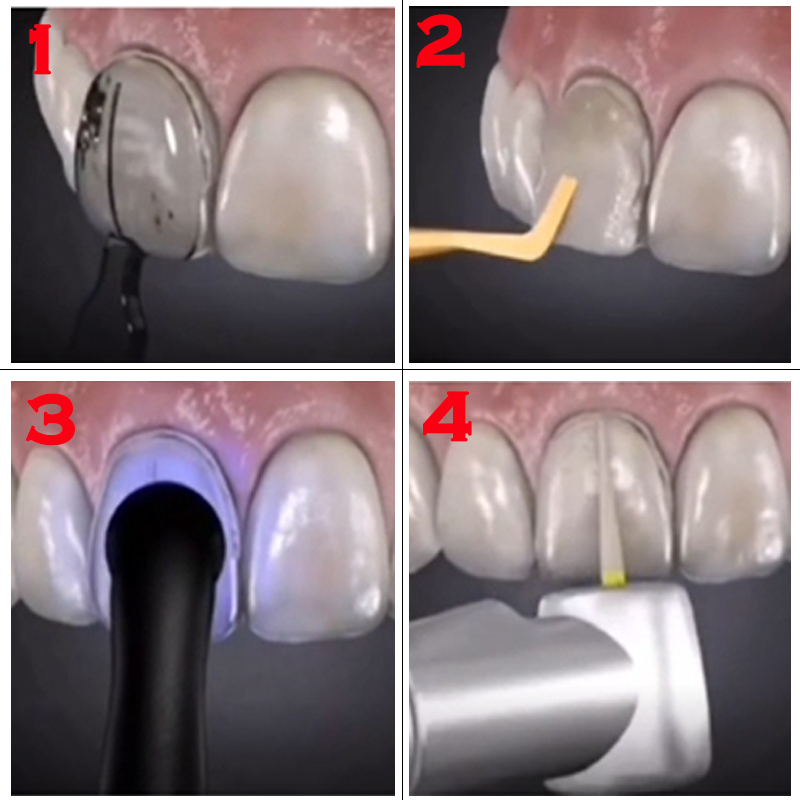 Tandheelkundige mal voor compo - Teeth Whitening Veneers recensie en prijs