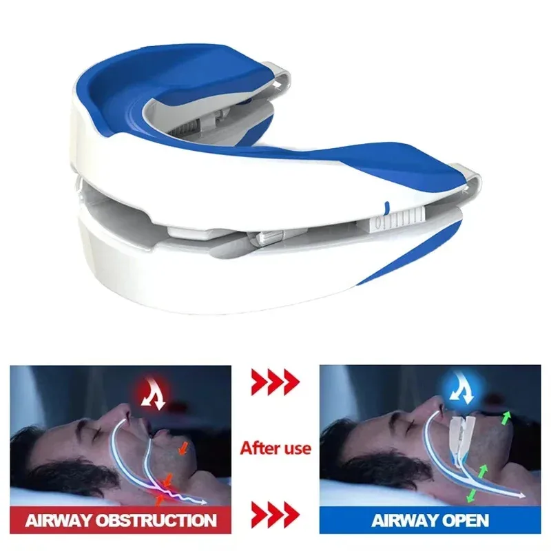 Verstelbaar anti-snorkel monds - Dental Guard Night recensie en prijs