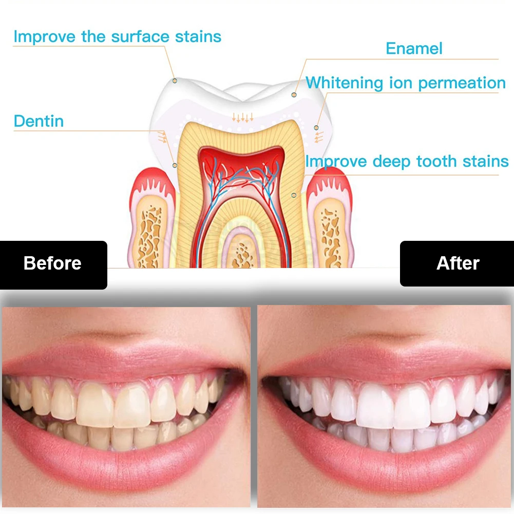 Tandheelkundige Tanden Whiteni - Teeth Whitening Kit With Light recensie en prijs