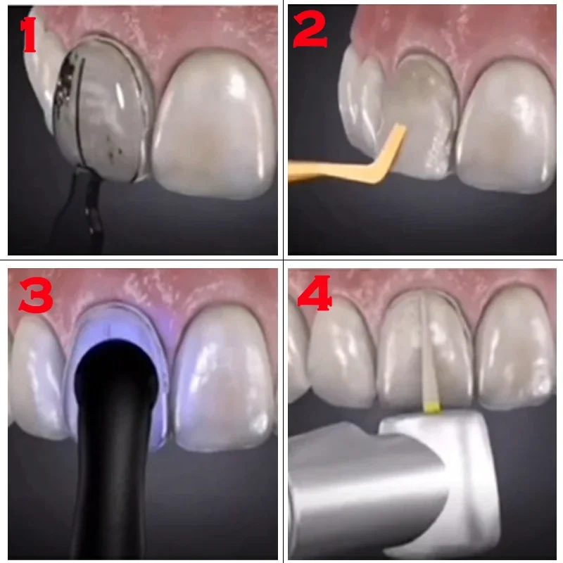 Tandheelkundige mal voor compo - Teeth Whitening Veneers recensie en prijs